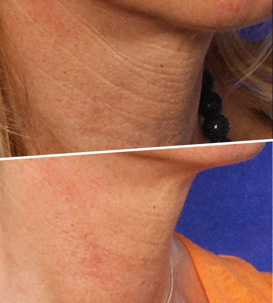 Neck Rejuvenation